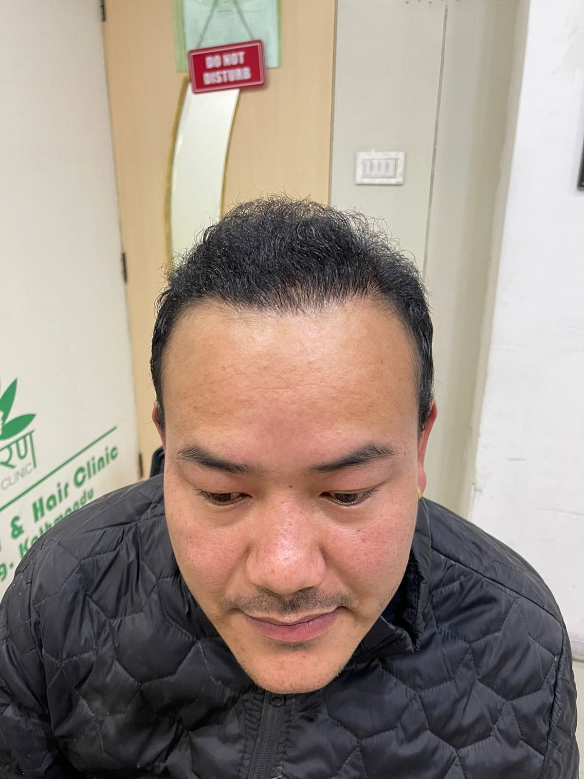 Hair Transplant