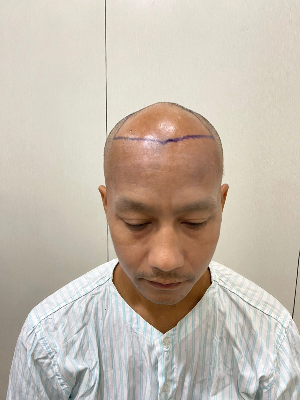 Hair Transplant