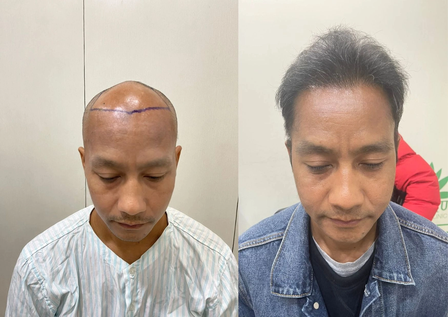 Hair Transplant
