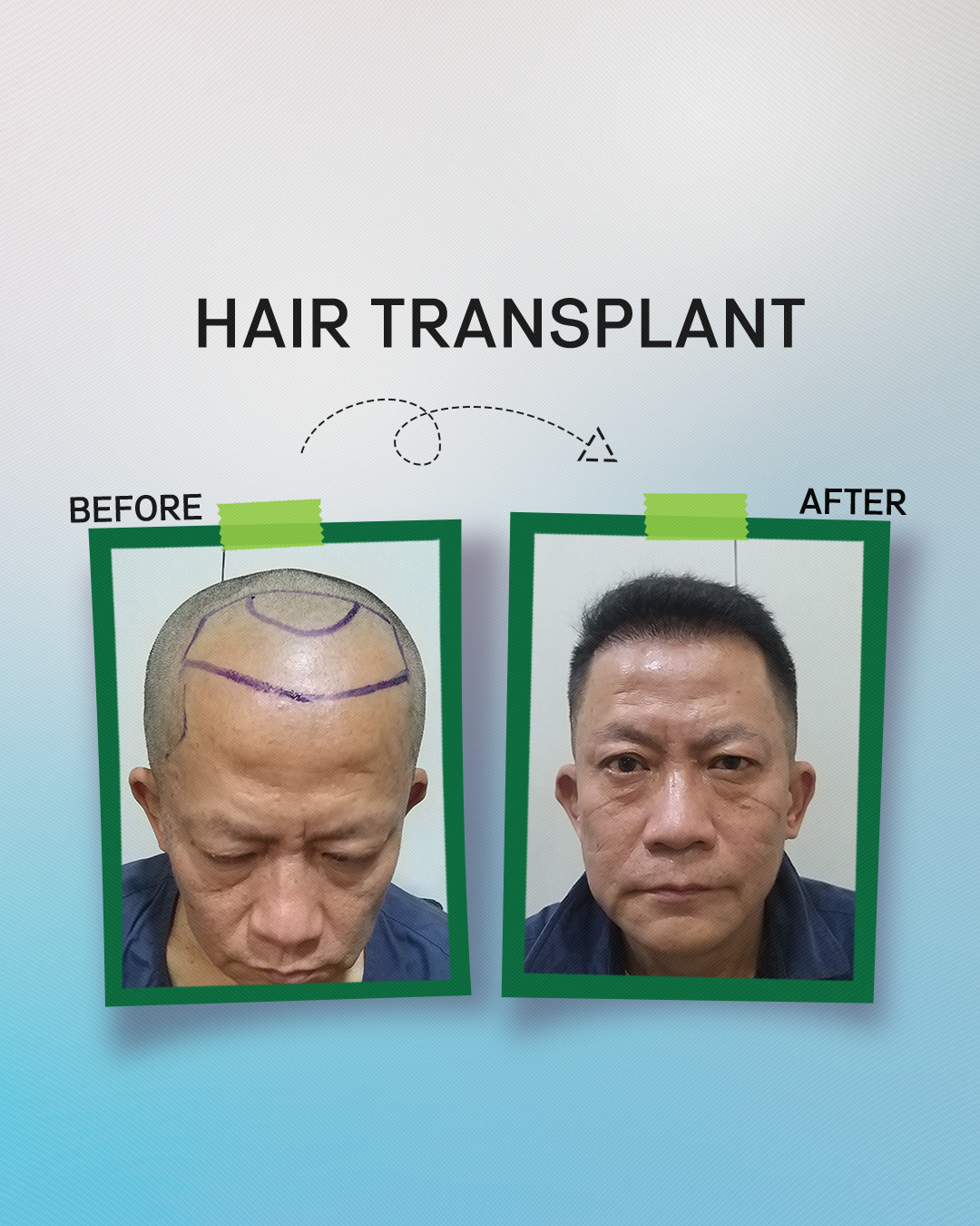Hair Transplant